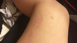 Pale Chubby Teen Showing off Stretch Marks on Thick Thighs - Scars